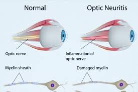 Image result for Optic Neuritis