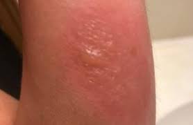 While many of the skin. Michigan Woman Treated For Brown Recluse Spider Bite Cbs News