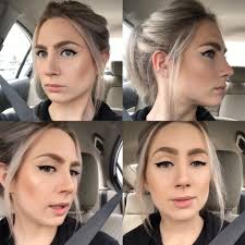 Nose Job Surgery Recovery Cast Removal Two Week Post Op Reveal Until The Very Trend Nose Job Nose Job Recovery Rhinoplasty Nose Jobs
