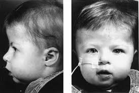 Craniosynostosis: Another feature of the 22q11.2 deletion syndrome