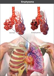 Image result for Emphysema