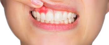 أسباب انتفاخ اللثة وطرق علاجها ويب طب