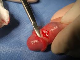 Det danner seg små sprekker på undersiden av forhud, som ved seksuell aktivitet utvikler seg til større sprekker. Forhudssykdommer Hos Barn Kirurgen