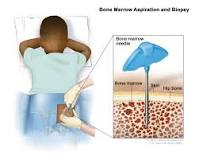 Image result for what cancer treatment is the best for progressive neuroblastoma cancer