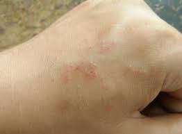 #魏嘉宏皮膚科診所 #冷凍溶脂 #一週年慶 #洢蓮絲 #原廠玻尿酸 #原廠肉毒 #皮秒蜂巢複合式療程 #雙眼皮手術 #眼袋手術 #埋線 #鳳凰電波 #美國音波 #精緻除毛 #hpv疫苗 #. è®Šç¨®ç—…æ¯' é¦¬ä¾†è¥¿äºžç¾è®Šç¨®ç—…æ¯'æ ªå‚³æ'­åŠ›é«˜10å€ç–«è‹—æˆ–ç„¡æ•ˆ Gotrip Line Today