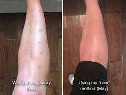 Flea Bites That Look Like Mosquito Bites Sand Flea Sand Fly Remedy Sand Fleas Fly Remedies Fly Bites Remedy