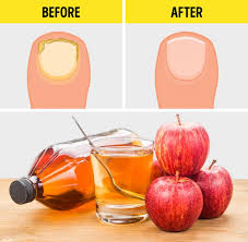 Apple cider vinegar uses and dosage. 50 Uses For Apple Cider Vinegar That Can Make Your Life Easier