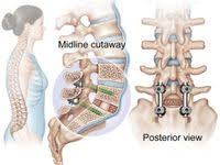 Revision Spine Surgery Second Opinion Spine Spinal Fusion Spine Surgery Spinal Fusion Surgery