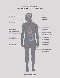 Learn how to treat and prevent pancreatic cancer with these amazing remedies. Pancreatic Cancer Symptoms Causes And Treatment