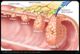 A low red blood cell count (anaemia), which can cause tiredness and weakness. Colon And Rectal Cancer Bayside Colorectal Group