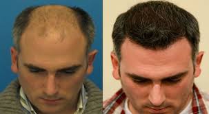 Other side effects not listed may also occur in some patients. Corticosteroid Betamethasone And Hair Loss Hairsite Com