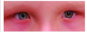 A fold of skin extending vertically over the inner angle of the eye: Prominent Epicanthic Folds Download Scientific Diagram