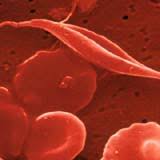 . führt ein defekt im hämoglobinmolekül dazu, dass die erythrozyten nur kurz überleben. Todliche Gene Als Lebensretter Scinexx De