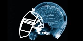 Common symptoms after a concussive traumatic you may have some symptoms of concussions immediately, and some can occur for days after the. Bennet Omalu Concussions And The Nfl How One Doctor Changed Football Forever Gq