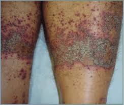 Image result for dermatitis contacta toxica