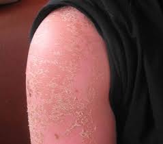 Erste Hilfe Bei Sonnenbrand Empfehlungen Von Hautarzten