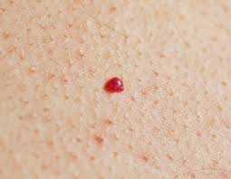 Red Moles On Skin Lovetoknow