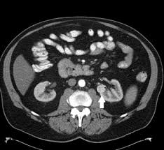 Fukuhara h, ichiyanagi o, midorikawa s, kakizaki h, kaneko h, tsuchiya n. Newer Approaches To Kidney Cancer Surgery May Involve Retro Strategies Renal And Urology News