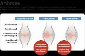 Arthrose Ratgeber I Ernahrung Behandlung