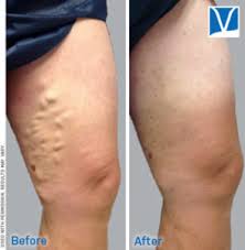When is varicose vein removal deemed a cosmetic treatment? When To Start Worrying About Varicose Veins