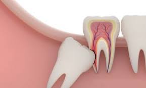 Removal of lower wisdom teeth : Tooth Extractions In Penge London Nhs Private Dentist In Se20