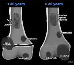 Cancers Of The Bone Medical School Stuff Metastatic Sarcoma