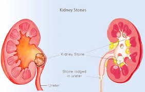 Padmini Urology Clinic Laparoscopy Dialysis Center Kidney Stone Surgery Removal And Cure Laser Treatment For Kidney Stone Gall Bladder Stone Ureteric And Urinary Stone Karaikudi Tamilnadu South India