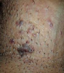 This starts with the anagen phase, which is the actual growth stage of the hair, gohil says. Get Rid Of Ingrown Hair Galhairs