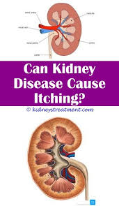Kidney Disease Stage 4 Polycystic Kidney Disease Kidney Disease Symptoms Chronic Kidney Disease