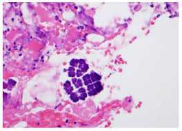 Sarcina ventriculi are gram positive bacteria which are found in water and soil and thrive in low ph as predicted in the literature this is the first case report of sarcina ventriculi in a patient with upper. Sarcina Ventriculi A Rare Case Of Life Threatening Perforated Gastric Ulcer And Review Of Literature Journal Of Gastric Surgery