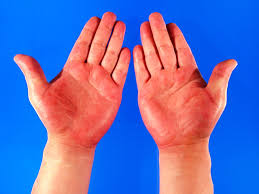 Erythema Palmare hereditarium (red palms): Lane's disease