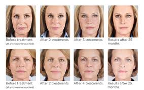 Andrea recommended sculptra aesthetic, which helps replenish lost collagen. Lisa Bunin Md Sculptra Allentown Pa