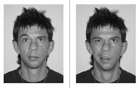 A randomised controlled trial of the use of aciclovir and/or prednisolone  for the early treatment of Bell's palsy: the BELLS s