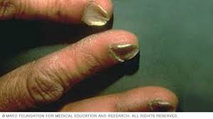 7 مشكلات في أظافر اليد لا ينبغي تجاهُلها - Mayo Clinic (مايو كلينك)