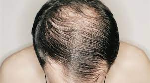 Punca rambut gugur di usia muda. 5 Faktor Keguguran Rambut Himalaya Healthcare Malaysia Facebook