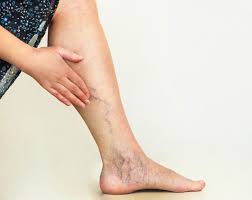 Image result for allergy rash on the legs