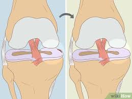 Check out our recommended best knee braces for a meniscus tear to speed up your recovery period. 10 Ways To Heal A Meniscus Tear Wikihow Fitness