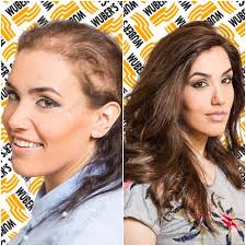 Il mercato è estremamente ampio e vario, posso dirti che puoi trovare protesi da 100€ fino a un massimo . Acquisto Comprare Protesi Capelli