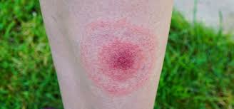 Image result for Fire Ant Sting