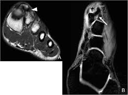 Posted by radiologyer at 8:12 am. Anatomical Variation In The Ankle And Foot From Incidental Finding To Inductor Of Pathology Part Ii Midfooot And Forefoot Insights Into Imaging Full Text