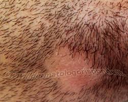 L'alopecia areata è un'affezione del cuoio capelluto conosciuta sin dall'antichità (già i medici greci e romani la descrissero nei propri trattati) che solo . Alopecia Areata In Dermatologia Come Riconoscerla Foto