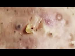Late night satisfying pimple popping! Big Open Closed Blackheads Removal The Best Pimple Popping Videos Youtube