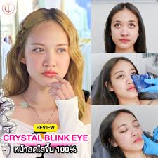 𝓒𝓻𝔂𝓼𝓽𝓪𝓵 𝓑𝓵𝓲𝓷𝓴 𝓔𝔂𝓮 แค่ฉี-ด = จบปัญหา!  เปลี่ยนหน้าหมองเหมือนโดนของให้สดใสขึ้นทันที . 🫧  ฟื้นฟูใต้ตาดำคล้ำให้กลับมาสดใส 🫧 ใต้ตากระจ่างใสขึ้นทันทีหลังทำ 🫧  เติมความชุ่มชื้นบริเวณใต้ตา . ที่ #อินชอนคลินิก การันตียาแท้ ไม่ปลอม  ไม่หิ้ว มี อย ...