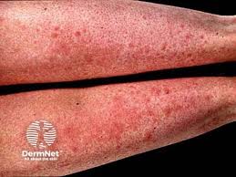 Image result for polymorphous eruption