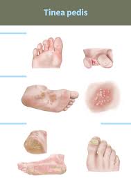 Image result for Tinnea vesiculosa