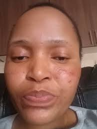 How to clear face breakouts caused by steroids?