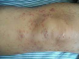 Bumps, lesions, scales, and blisters can all be classified as skin rashes. Skin Cancer And Rashes Cancerous And Precancerous Lesions