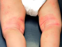 Eczeem of droge huid kind / baby