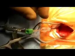 Eine gartenpumpe ist eine selbstansaugende pumpe und wird häufig für die bewässerung von wird geladen. Pump Implantation By Joe Ordia M D Mp4 Youtube