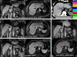 Comprehending The Therapeutic Effects Of Stereotactic Body Radiation Therapy For Small Hepatocellular Carcinomas Based On Imagings